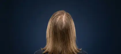 Łysienie rozlane